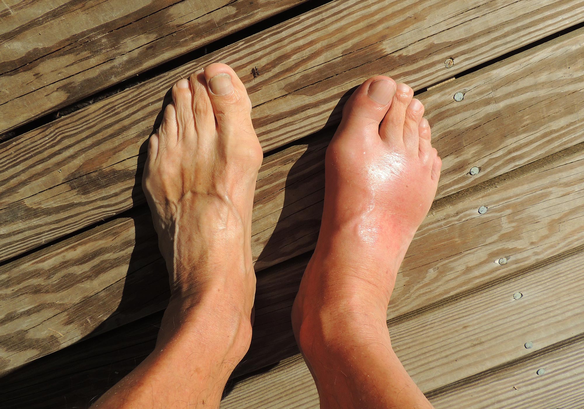 Gout
