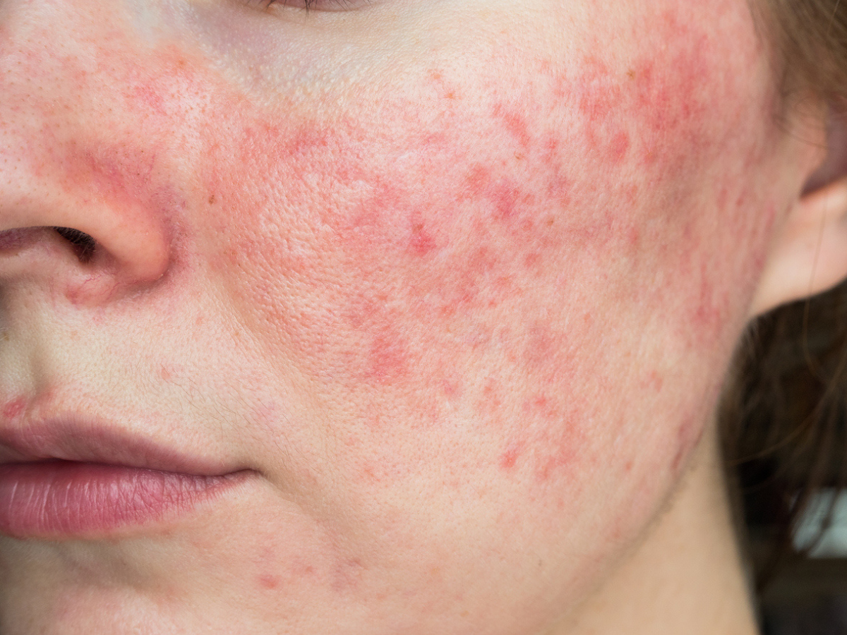 Lupus