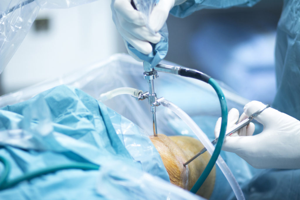 Pre-Arthroscopy procedure
